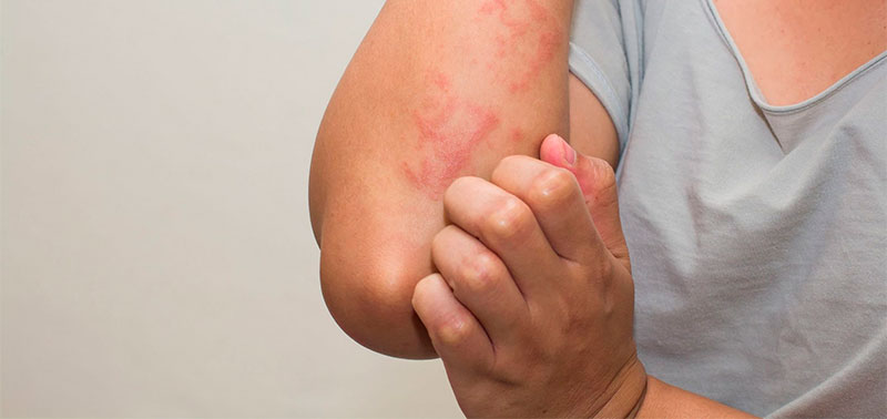 La dermatitis atópica necesita cuidados