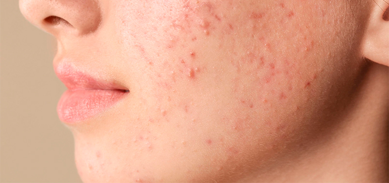 El acné puede empeorar en la regla
