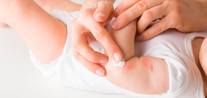 La dermatitis puede afectar la piel del bebé