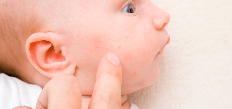 Existe un tipo de acné neonatal